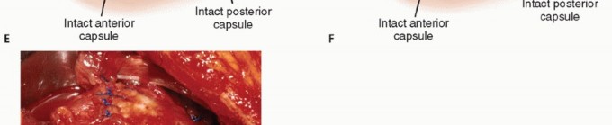 Illustration 29 for Subscapularis & Teres Rotator Cuff Repair: Advanced Techniques