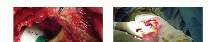 Illustration 15 for Cemented Total Hip: A Successful & Evidence-Based Solution