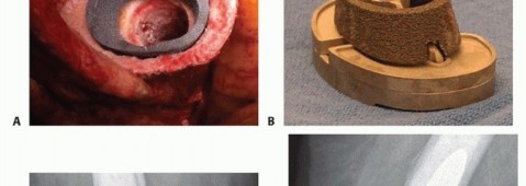 Illustration 5 for Tibial Bone Loss in TKA Revision: Augments for Complex Cases