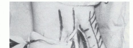 Beyond Primary Repair: Solutions for Peroneal Tendon Subluxation