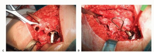 Illustration 32 for Special THA Techniques for Severe Deformities Around the Hip