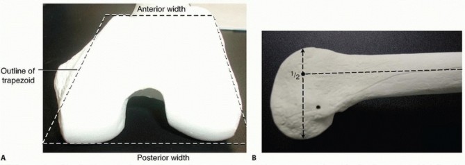 Illustration of fixation of the distal - Dr. Mohammed Hutaif