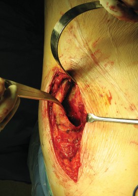 Illustration 29 for Figure Hip Resurfacing: Who Benefits and Who Should Avoid It?