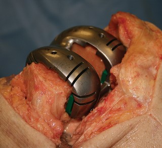 Illustration 21 for Understand Augments: The Role of Metal Augments in Arthroplasty