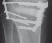 Illustration 46 for Guide Pin Assembly: Key to Flawless Upper Tibial Osteotomy