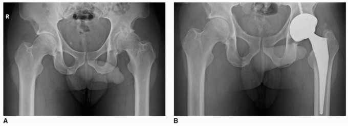 Illustration 10 for Mastering The Uncemented Socket: Ensure Lasting Hip Fixation