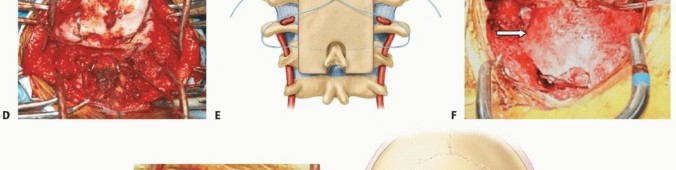 Illustration 24 for Addressing Cervical Spine Instability with Posterior Arthrodesis