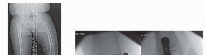 Illustration 5 for Optimizing Growth to Correct Pediatric Limb Deformities