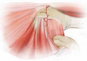Illustration 8 for FAI: Impingement and Surgical Dislocation Explained