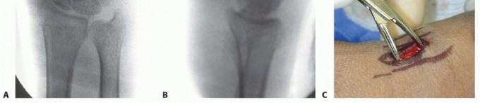 Illustration 14 for Effective K-Wire Fixation: Distal Radius Fractures Without External Fixation