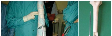 Illustration 15 for The Proxima: Why This Proximally Loading Implant Preserves Bone