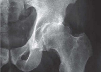 Illustration 29 for Optimizing Acetabular Component Cementation for Superior Outcomes