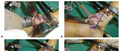 Illustration 63 for Mastering Midfoot Arthrodesis: Protect the Deep Neurovascular Bundle