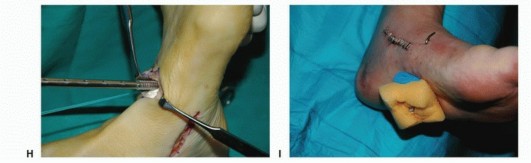 Illustration 38 for Foot Drop Surgery: How a Pin or Drill Elevates Tendon Transfer