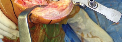 صورة طبية: استبدال مفصل الركبة بالحد الأدنى من التدخل الجراحي: ألم أقل وتعافٍ أسرع مع النهج شبه الرضفي الإنسي