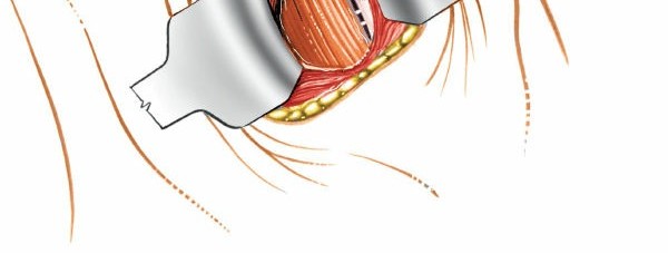 Illustration 250 for Approach to the Lumbar Spine: Mastering Techniques & Anatomy