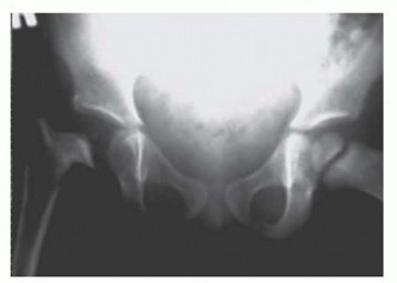 Illustration 22 for Septic Hip in Children: Mastering Anterior Drainage for Optimal Recovery