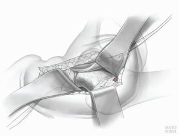 صورة توضيحية لـ النهج الأمامي لاستبدال مفصل الورك الكلي: ثورة في جراحة الورك مع الأستاذ الدكتور محمد هطيف في صنعاء