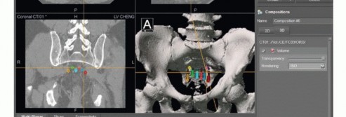 Illustration 47 for Sacral Tumor Surgery: Safeguarding Bowel & Bladder Control
