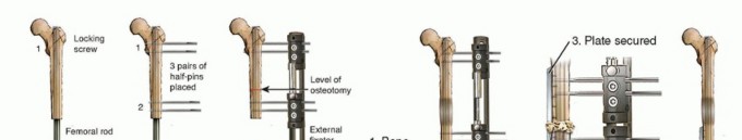 Illustration 17 for Knee Arthrodesis: A Solution for Stable Femur & Tibia Fusion