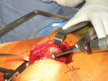 Illustration 69 for Successful Total Hip Replacement in Developmental Dysplasia