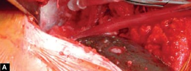 Illustration 15 for Optimizing Acetabular Component Cementation for Superior Outcomes