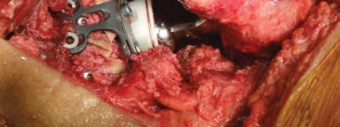 Illustration 41 for Optimizing Arthroplasty in Acute Fractures: Octopus System