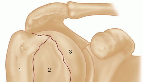 Hemiarthroplasty for Proximal: Effective Treatment for Fractures