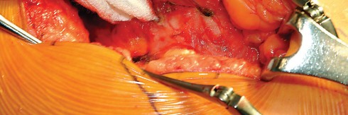 Illustration 42 for Direct Lateral Hip: Optimize Exposure with Sharp Curved Hohmann