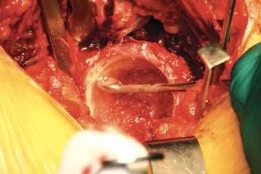 Illustration 54 for Birmingham Hip Resurfacing Designer's Technique for Active Lives