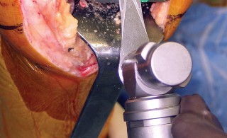 صورة طبية: استبدال مفصل الركبة بالحد الأدنى من التدخل الجراحي: ألم أقل وتعافٍ أسرع مع النهج شبه الرضفي الإنسي