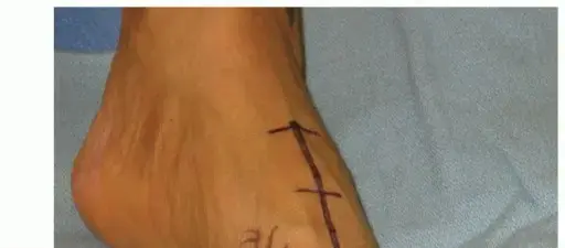 عملية لابيدوس للوكعة الإبهامية: دليل شامل للمرضى في اليمن والخليج العربي مع الأستاذ الدكتور محمد هطيف