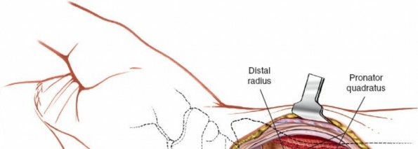 Illustration 10 for Volar Approach: Optimal Exposure for the Volar aspect of the Distal Radius