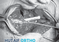 Illustration 17 for Cervical Fusion: The Line is Drawn for Lasting Stability