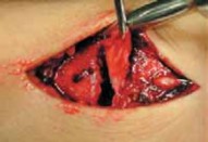 Illustration 13 for Pediatric Ankle Fractures: Management to Prevent Long-Term Issues