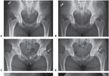 Illustration 199 for Mastering the Scope for Femoroacetabular Impingement