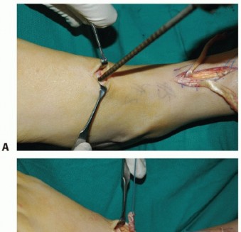 Illustration 54 for Restore Movement: Tendon Transfer for Common Peroneal Nerve Foot Drop