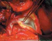 Illustration 27 for FAI: Impingement and Surgical Dislocation Explained