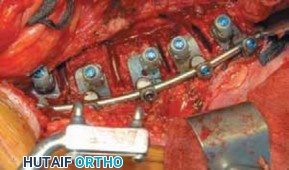 Illustration 45 for Mastering Anterior Interbody Arthrodesis with Instrumentation for Scoliosis