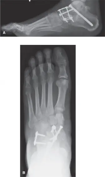 تنضير وتر قصبة الساق الخلفية: دليل شامل لعلاج آلام القدم المسطحة المكتسبة