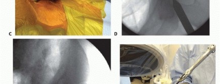 Illustration 36 for Emergency Fixation of the Pelvis: Control Bleeding & Restore Stability