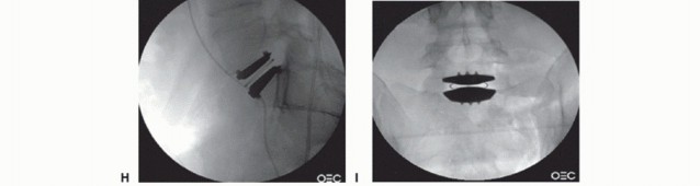 Illustration 17 for Anterior Lumbar Interbody: Fusion, Disc Replacement & Pain Relief