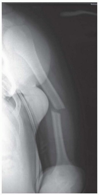 Enhance Recovery: Humeral Plate Fixation for Brachialis & Brachioradialis