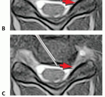 Illustration 15 for How ACDF Clears Your Posterior Disc Space for Lasting Relief