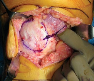 Illustration 5 for Minimally Invasive Subvastus: The Best Path to Quicker TKA Recovery