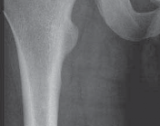 Illustration 37 for Resolving Femoral Head Neck Impingement: Arthroscopic FAI Solutions