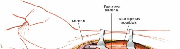 Illustration 31 for Volar Approach: Optimal Exposure for the Volar aspect of the Distal Radius