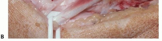 Illustration 13 for Precision Correction for Distal Radius Malunion