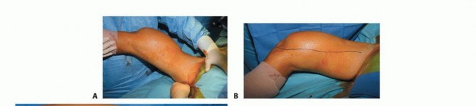 Illustration 25 for Advanced Distal Femoral Resections: Limb-Sparing Outcomes & Techniques