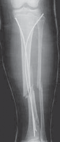 Illustration 22 for Pediatric Tibial Fractures: Avoid Mistakes, Ensure Optimal Healing